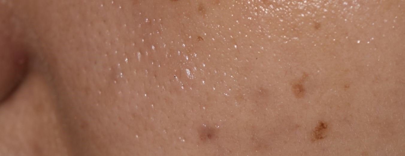 peau grasse déshydratée