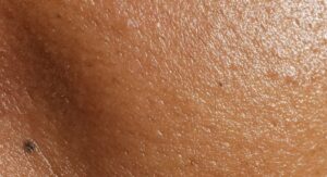 Peau grasse qui brille
