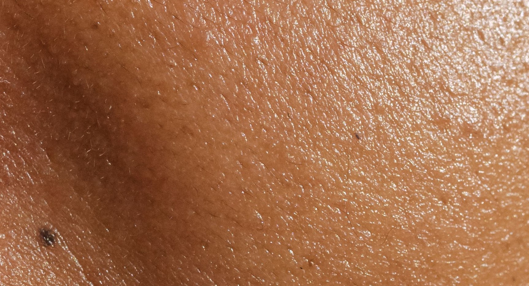 Peau grasse qui brille